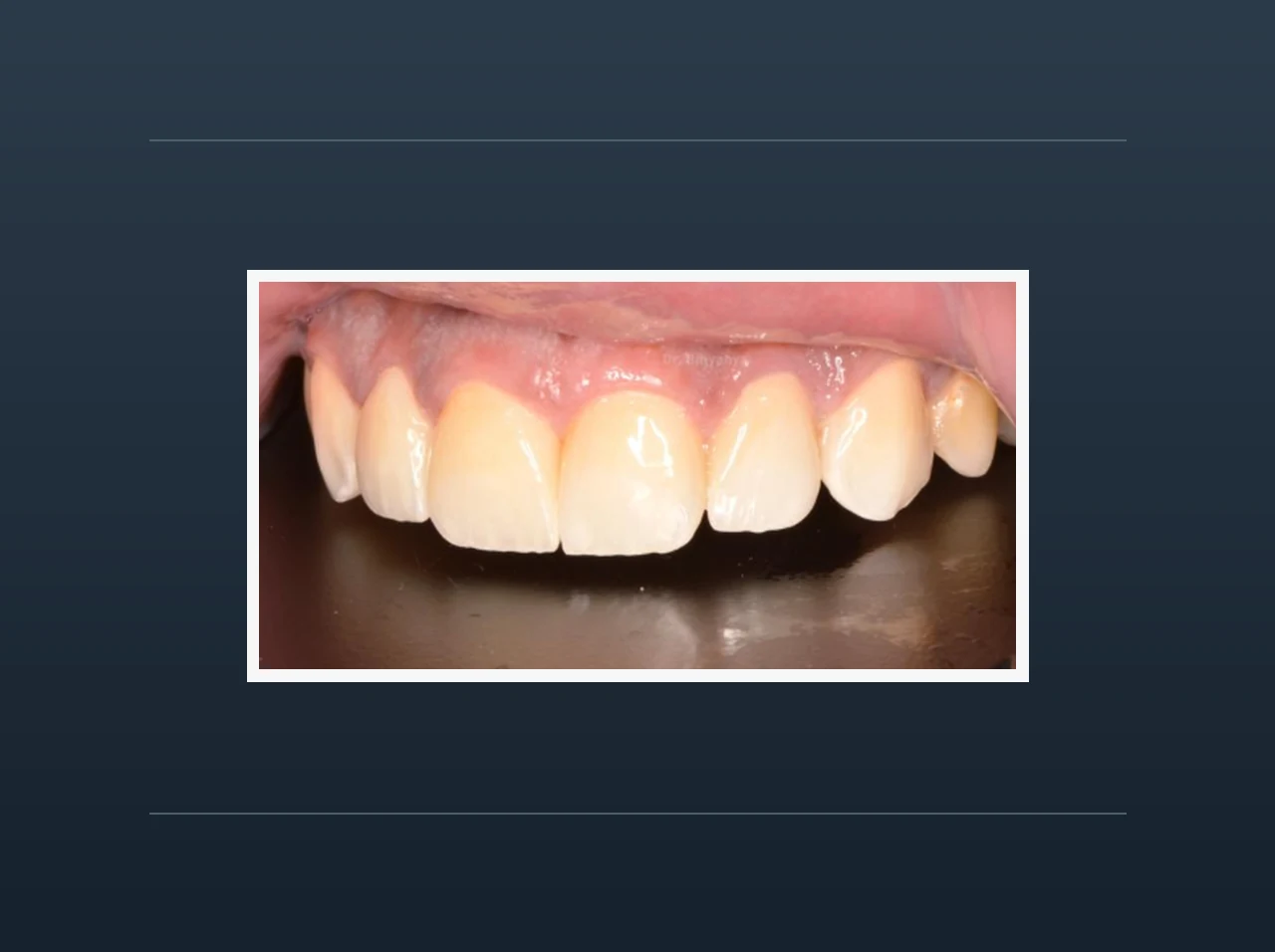 The clinic’s work on upper front teeth, in a white frame on a navy background
